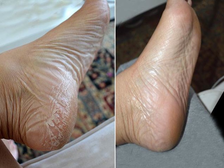 Baby Foot Peel Review: Results, Photos, and Before and After - The