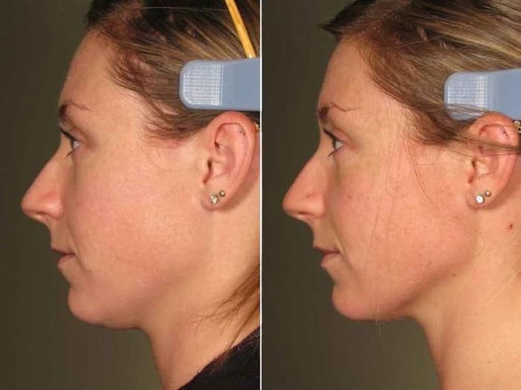 Ultherapy: Reviews &amp; Cost Before &amp; After Pictures