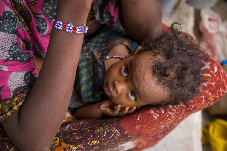 Image: A malnourished baby in Dubti Woreda, Ethiopia