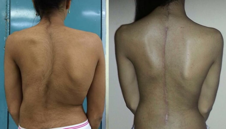 Before and after back surgery