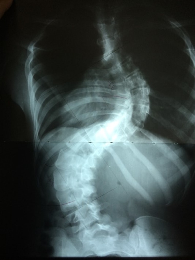 x-ray, scoliosis