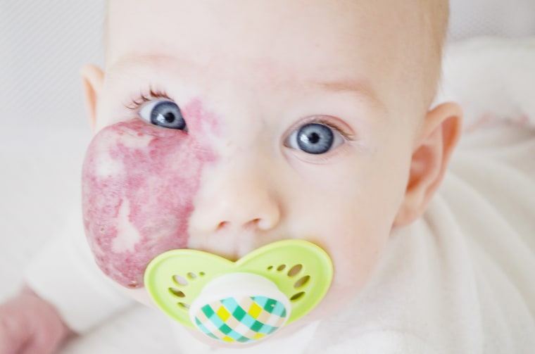 7-month-old Charlie has capillary hemangioma.