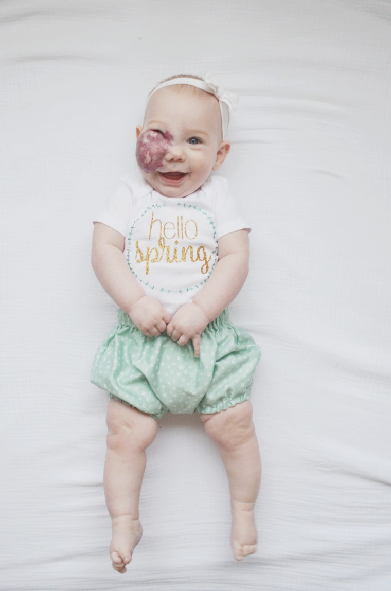 7-month-old Charlie has capillary hemangioma.