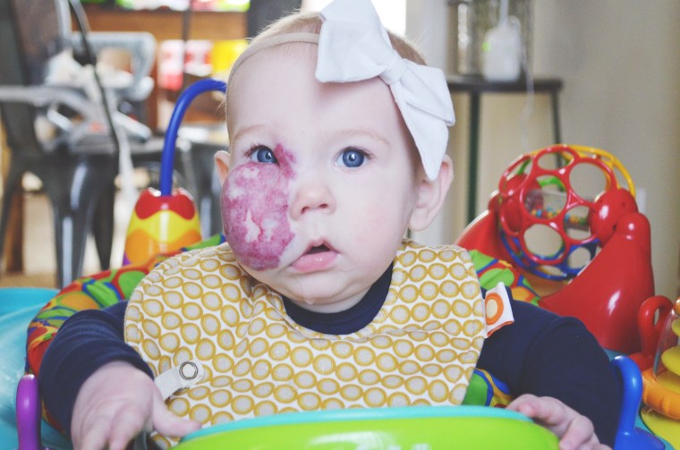 7-month-old Charlie has capillary hemangioma.