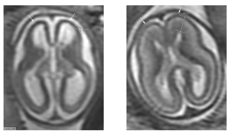 Image: Zika effects on fetus