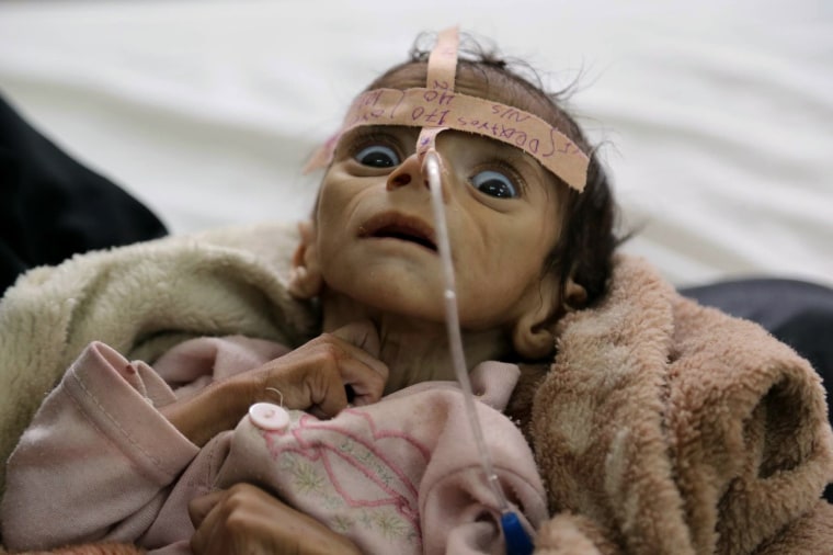 Image: Yemen War Hunger