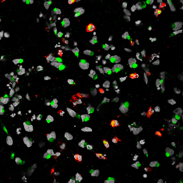 Genetic mutations in the Zika virus, shown here (in green) infecting neural cells, could cause it to replicate more efficiently, evade the body's immune response or invade new tissues.
