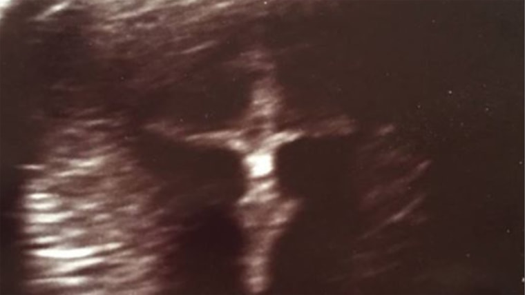 image of a crucifix found on woman's ultrasound