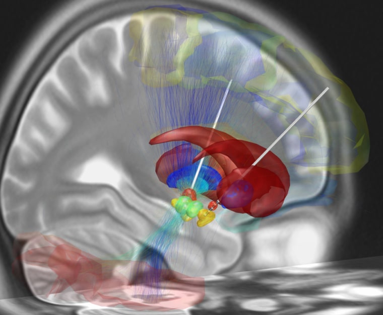 A reconstruction of deep brain stimulation depicts electrodes that have been surgically placed into the most common target structure for treatment of Parkinson's disease, the subthalamic nucleus (orange). The STN is part of the brain's stopping system and is a particular focus of this study.