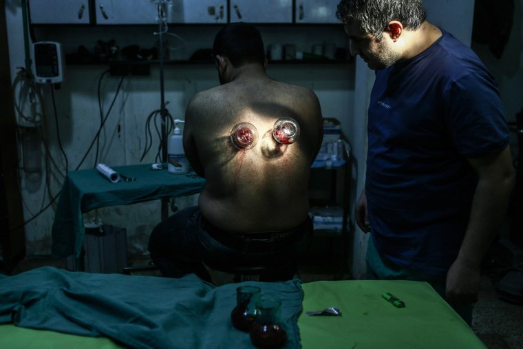 Image: Cupping theraphy in Douma field hospital