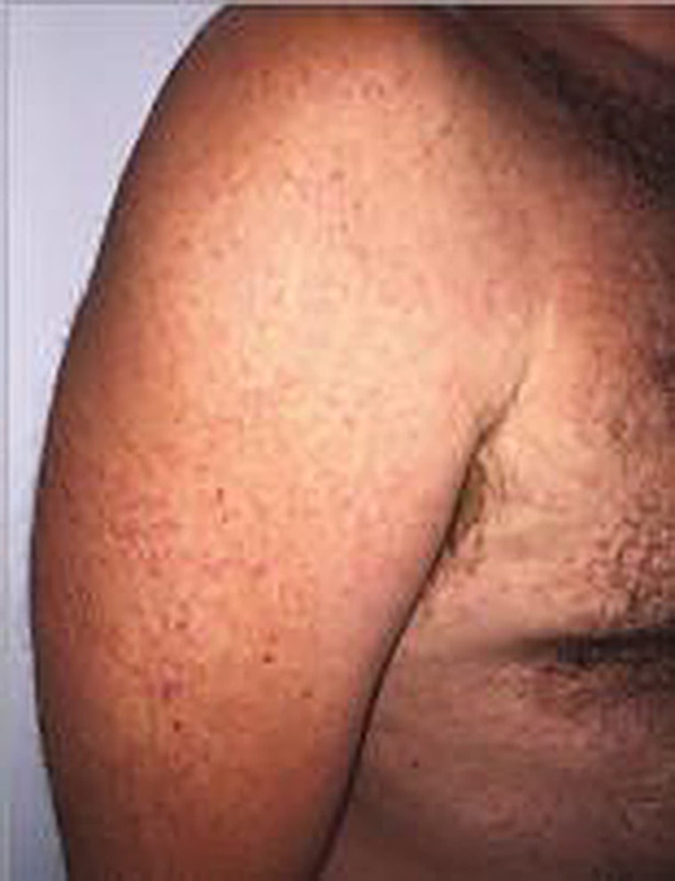 A 44-year-old man developed a painful rash when he became infected with Zika virus in Puerto Rico.