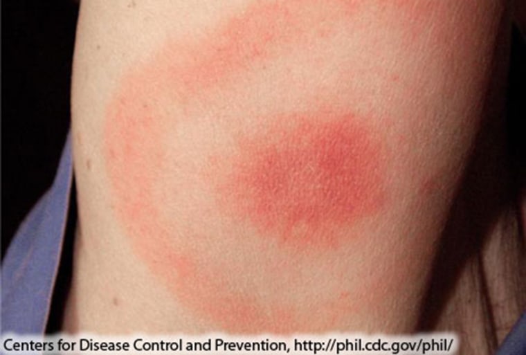 "Classic" Lyme disease rash