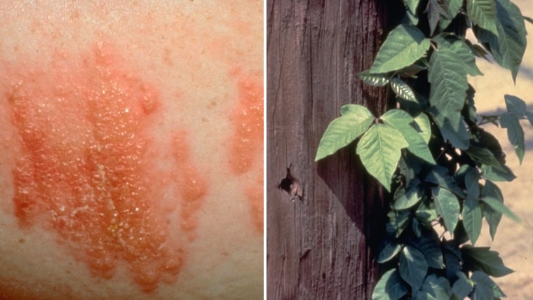 Poison ivy and other summer skin irritants - Mayo Clinic