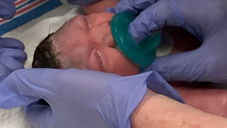 Image: A baby was born with microchephaly at Hackensack Medical Center, New Jersey.