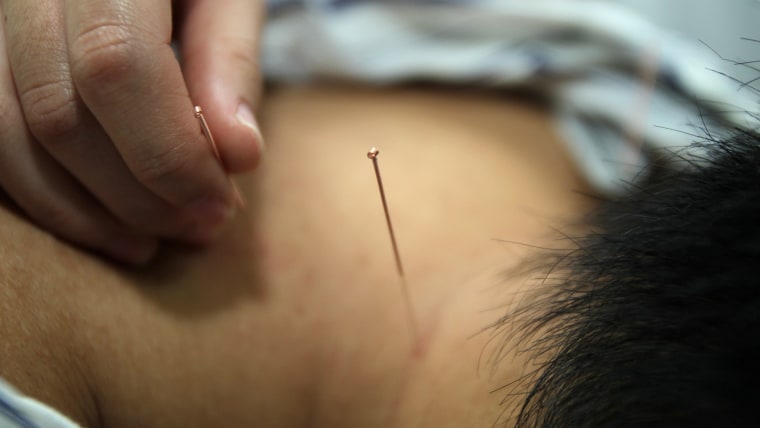 China's Acupuncture Listed On Intangible Cultural Heritage