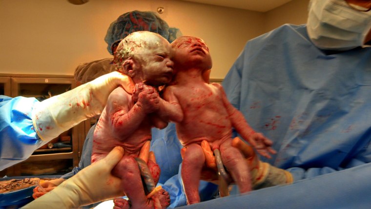 Jenna and Jillian Thislethwaite, just seconds after they were born in 2014.