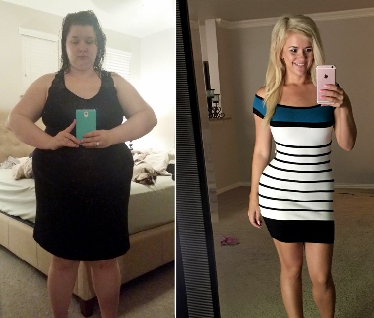 Laparoscopic gastric sleeve surgery helps woman lose 150 pounds