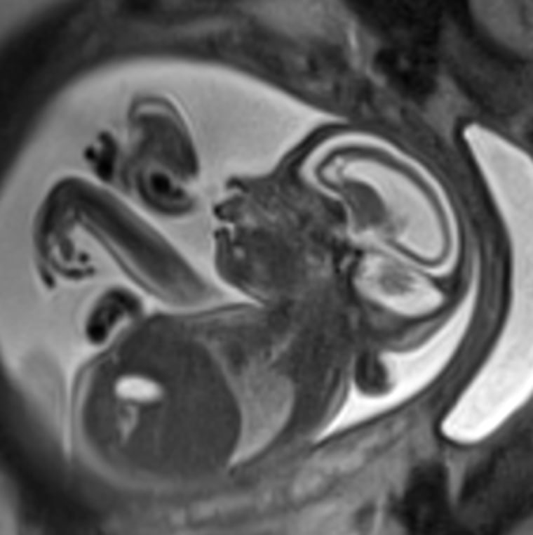 A special MRI at Children's National Health System can image a developing fetus and help doctors better track any damage caused by Zika virus. This image shows the profound brain damage that Zika can cause. White areas show missing brain matter.
