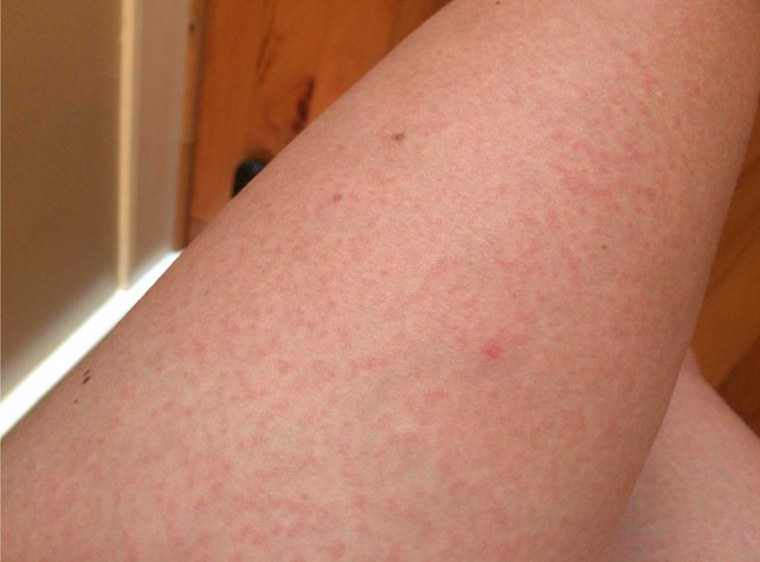 A picture of the rash on the patient's arm. It didn't itch or hurt, Satu says.