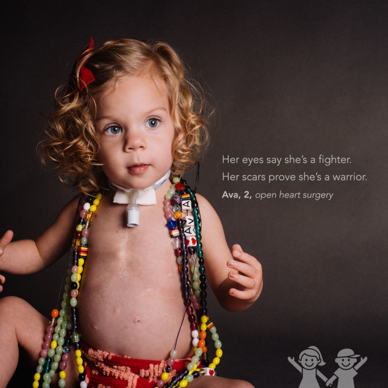 kids show off scars in photo series
