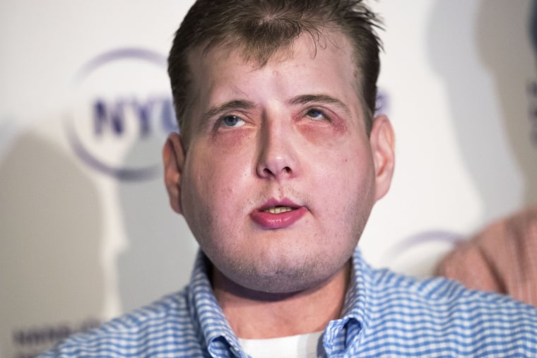 Image: Extensive Face Transplant Patient Discusses Recovery In New York