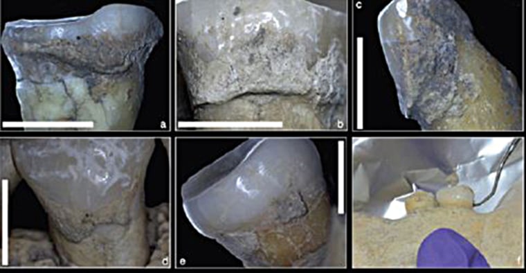 A study of plaque on the teeth of skeletons found in modern-day Serbia shows evidence of processed grains, as well as peas or beans, the team reports.