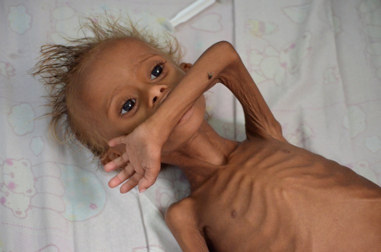 Image: Malnourished boy lies on a bed at a hospital in the Red Sea port city of Houdieda