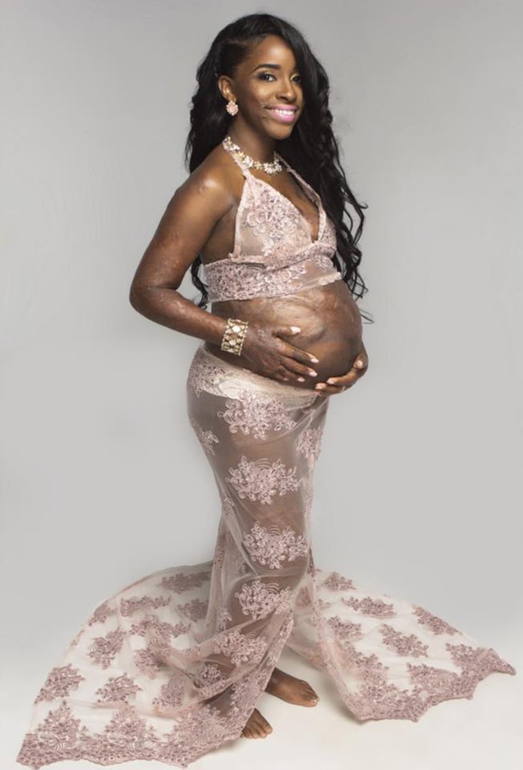 Burn survivor's pregnancy photos go viral