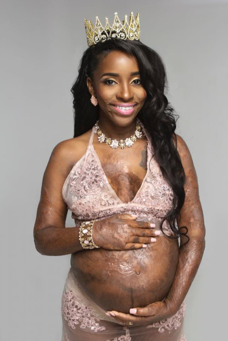 Burn survivor's pregnancy photos go viral