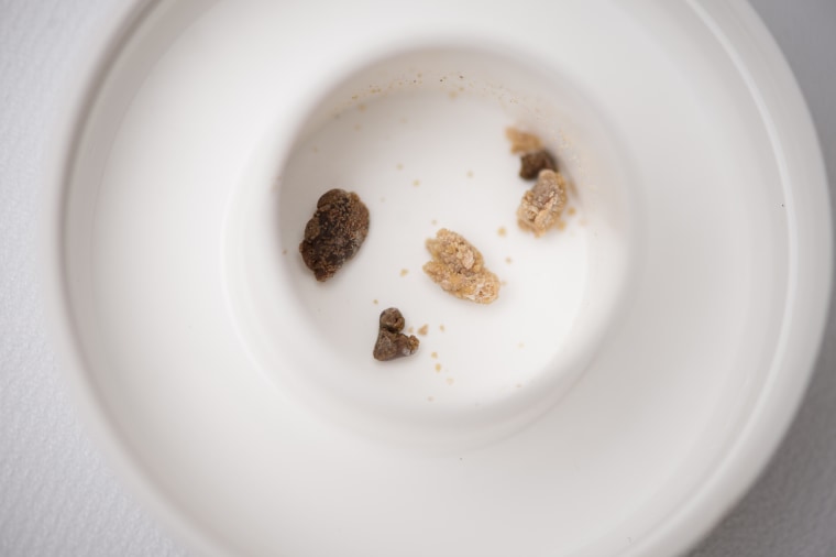 Image: Kidney stones sit in a jar in the office of Dave Wartinger