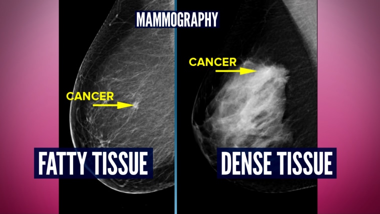 Mammography showing breast cancer