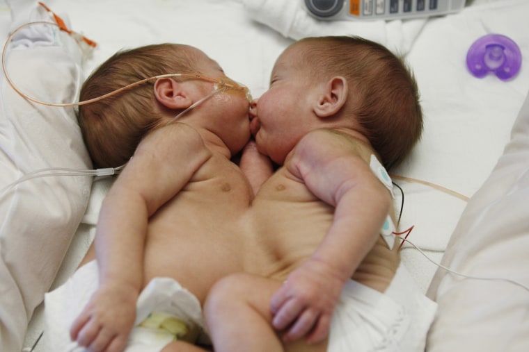 conjoined twins Selah and Shylah Oglesby