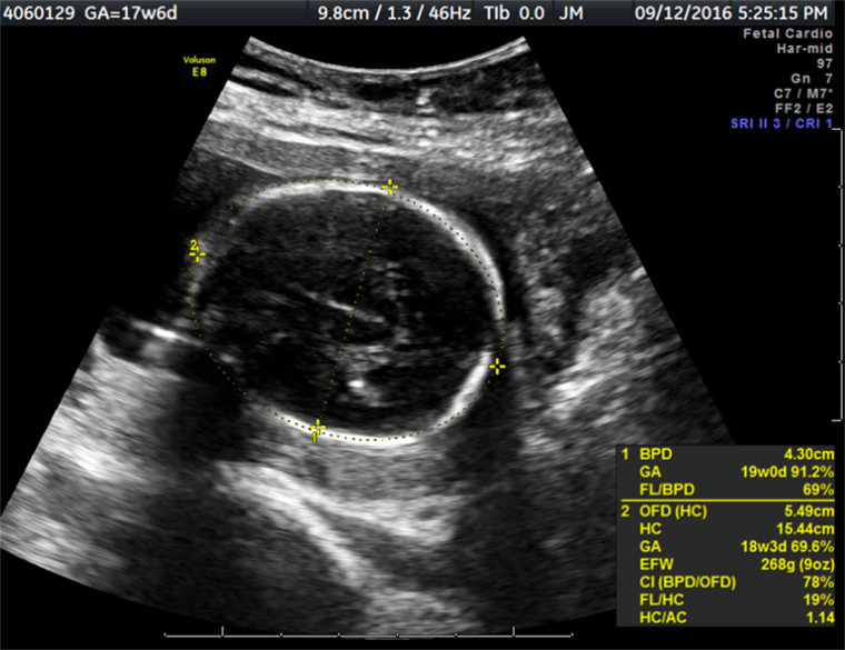 Image: An ultrasound image of Yessica Lopez pregnancy