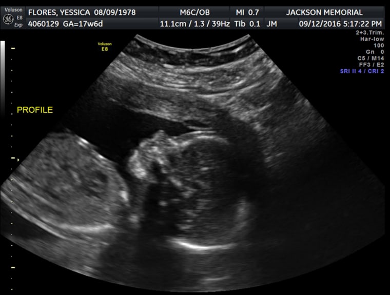 Image: An ultrasound image of Yessica Lopez pregnancy.