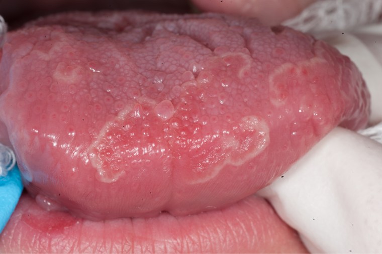 geographic tongue