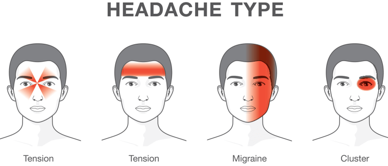 Where 3 different types of headaches hurt worst: a tension headache is felt all over the head; a migraine often on one side of the face; and a cluster is a "horrible pain" around the eyes.