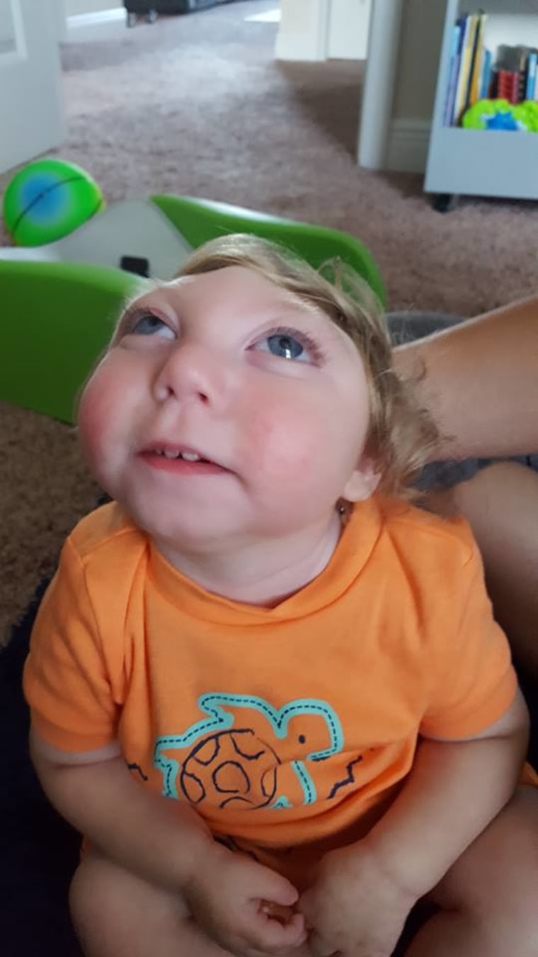 Jaxon Buell was born with part of his brain missing.