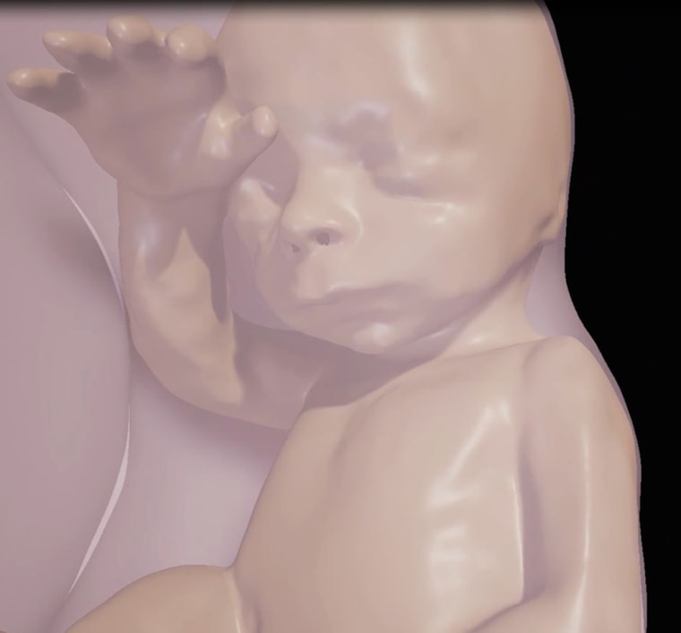 Image: Close-up of fetus at 26 weeks