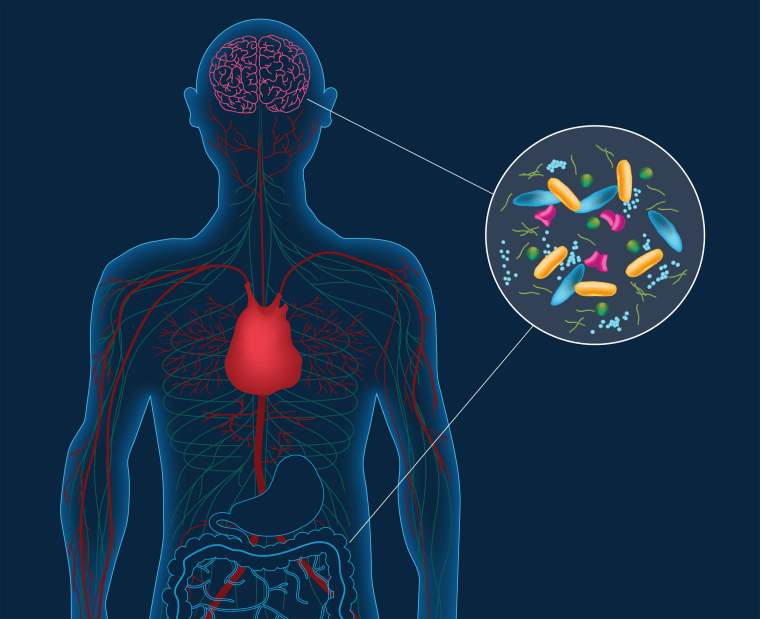 Artist's concept depicting microbes in the gut instigating changes in the brain that can lead to Parkinson's disease. People with Parkinson's harbor distinct gut bacteria that influence the disease's severity.