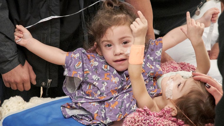 Handout photo of Erika and Eva Sandoval before their separation surgery in Palo Alto, California