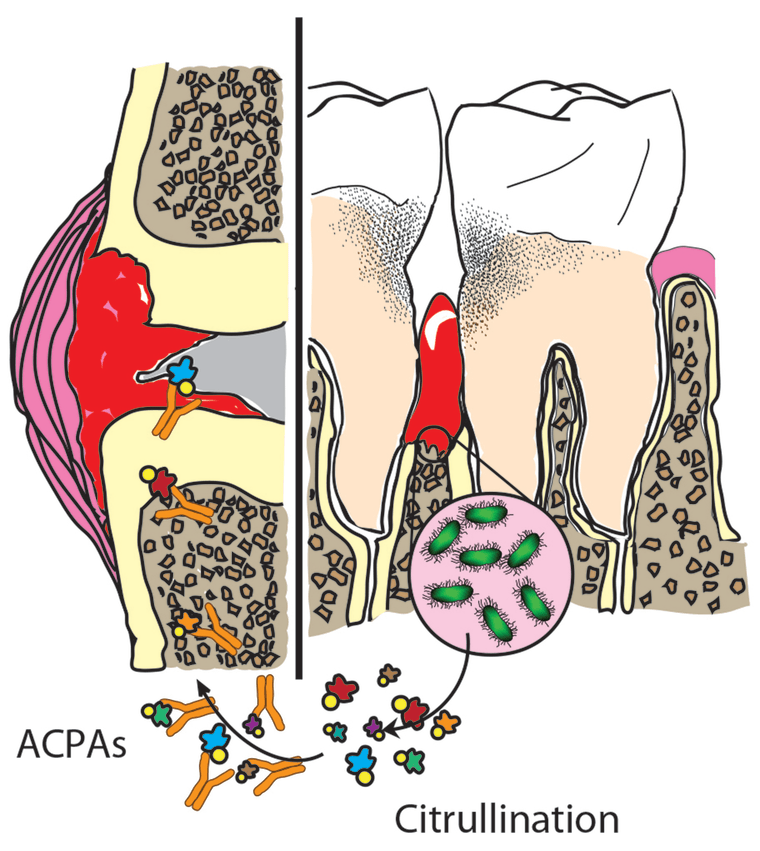 The figure shows periodontal disease on the right and a rheumatoid joint on the left. The periodontal pathogen Aa (shown in the magnification) drives the production of citrullinated proteins, which initiate an antibody response. 