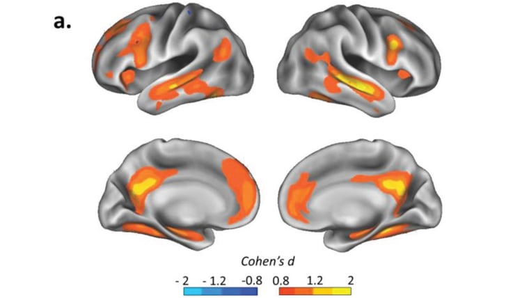 Pregnancy brain change