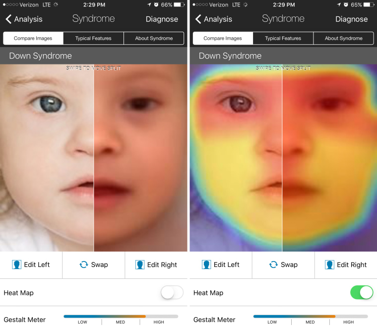 Image: Facial recognition app Face2Gene is being used by doctors to diagnose rare diseases