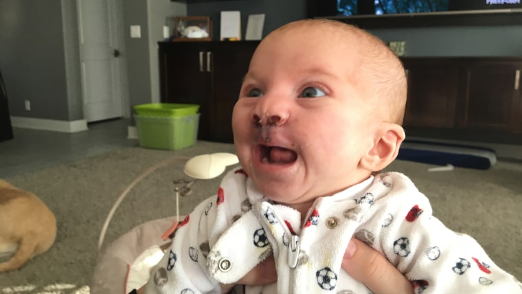 Even four days after lip repair surgery, 3-month-old Brody was all smiles.