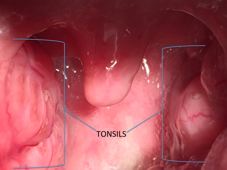 Tonsils