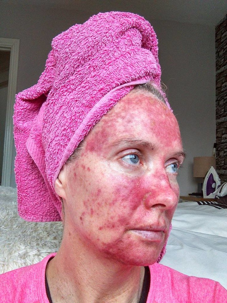 Margaret Murphy has actinic keratosis