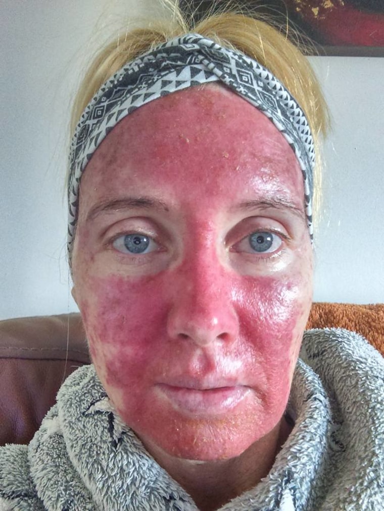 Margaret Murphy has actinic keratosis