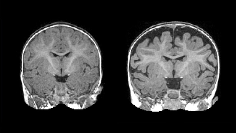 Right: MRI of a baby at 6 months who was diagnosed with autism at 2 years. The dark space between the brain folds and skull indicate increased amounts of cerebrospinal fluid. Left: MRI of a baby who was not diagnosed with autism at age 2. Note the decreas