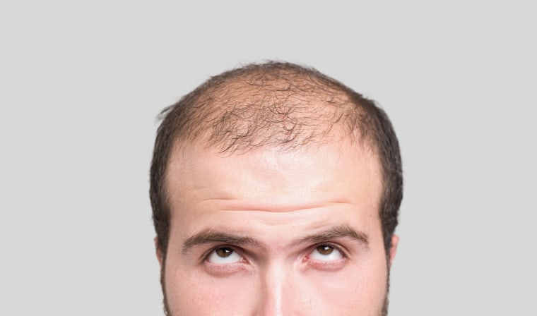 Bald young man, front view