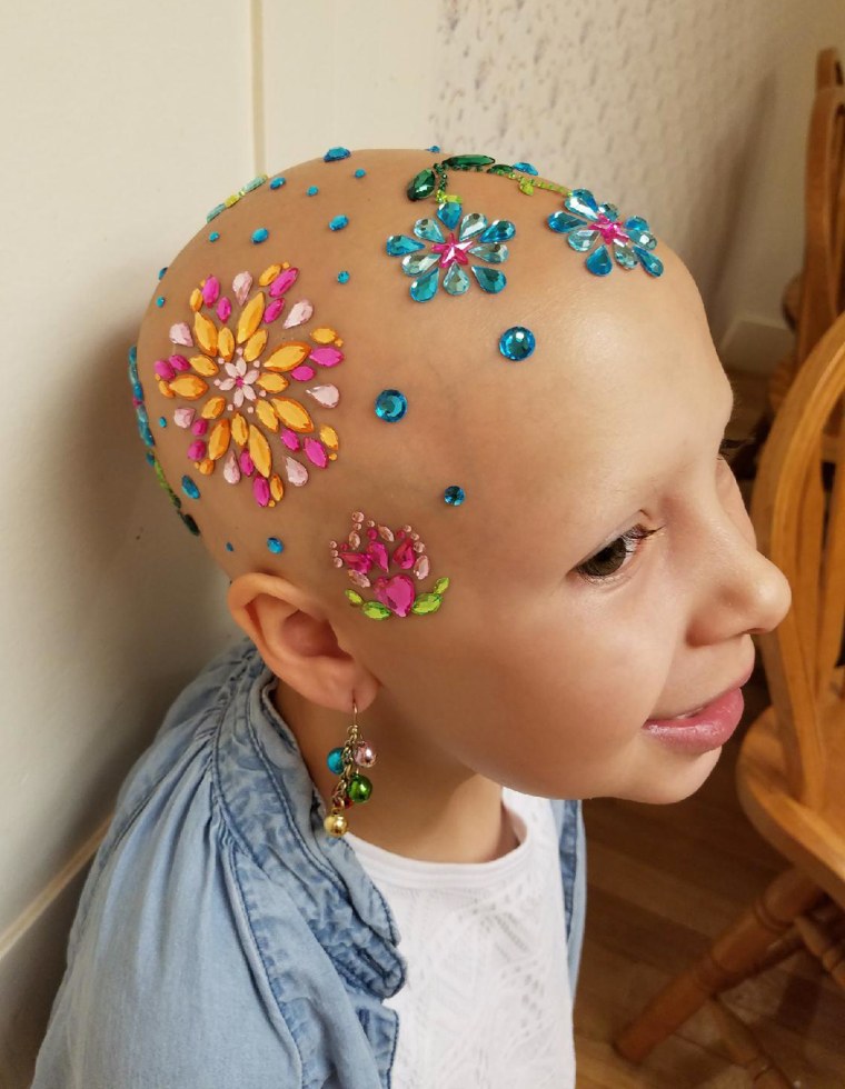 Girl with alopecia